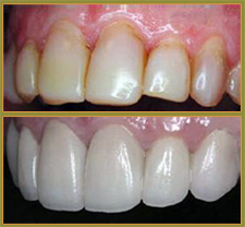 BEFORE & AFTER TREATMENT