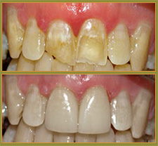 BEFORE & AFTER TREATMENT